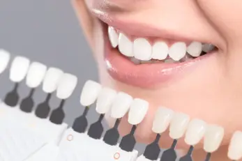 Laser Teeth Whitening